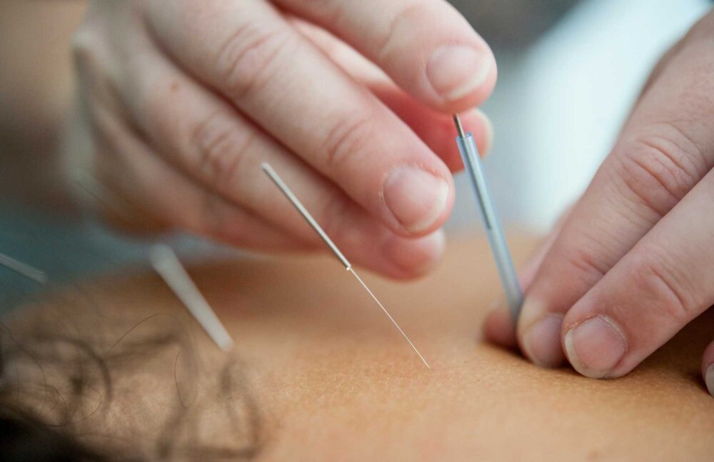 dry needling, sports massage, remedial massage